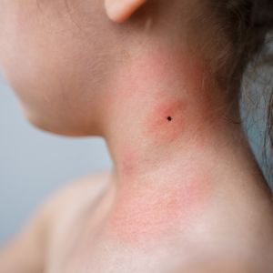 Lyme hastalığı hakkında bilmeniz gerekenler