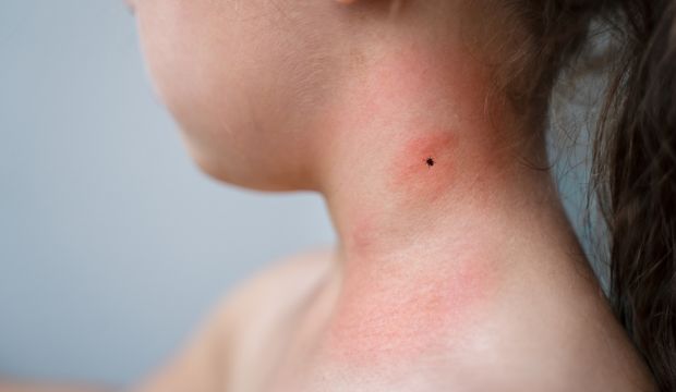 Lyme hastalığı nedir? Lyme hastalığı tedavisi nasıldır?