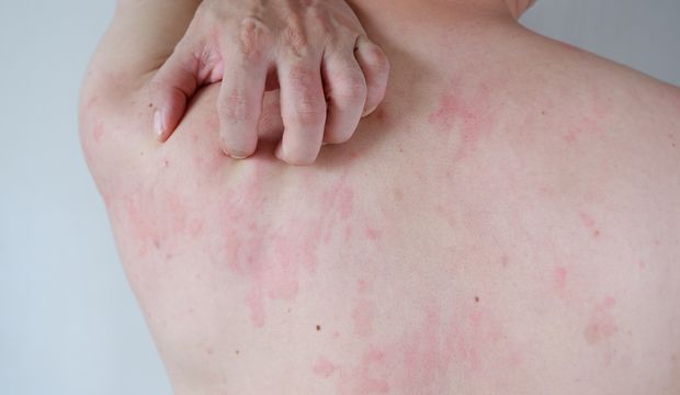 Ürtiker nedir? Ürtiker neden olur?