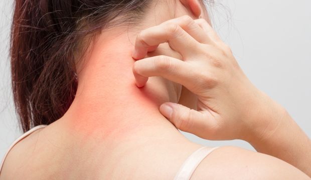Alerji nedir?