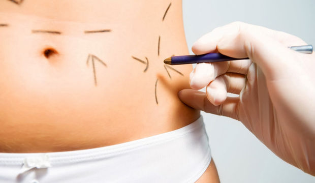 Lazer lipoliz nedir?