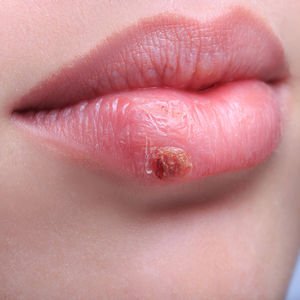 Zayıflayan bağışıklık sisteminin 5 sinyali