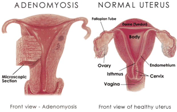 Utero adenomiosis
