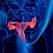 Yumurtalıkların aşırı uyarılması (OHSS) nedir?
