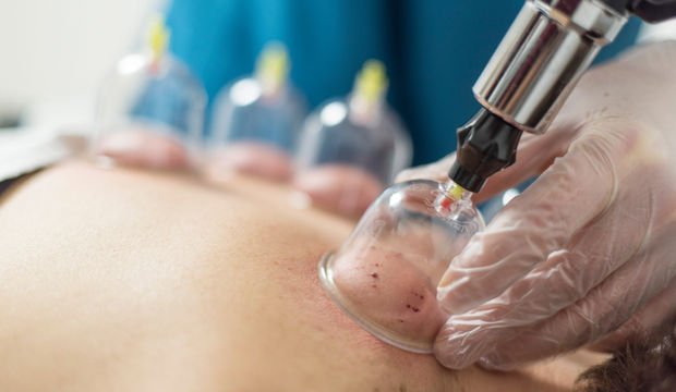 Hacamat nedir? Hacamat nasıl yapılır?