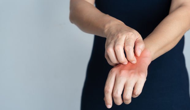 Uyuz nedir? Uyuz neden olur?