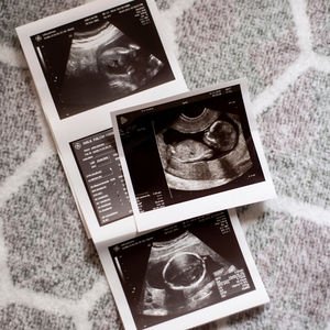 Ultrason terimleri ne anlama gelir?