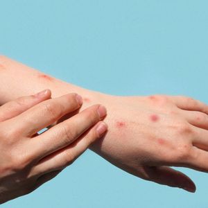 Acil durum ilan edildi: Maymun çiçeği virüsü 