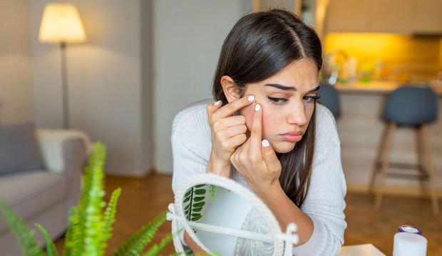 Sivilce sıkmanın cilt sağlığına etkileri